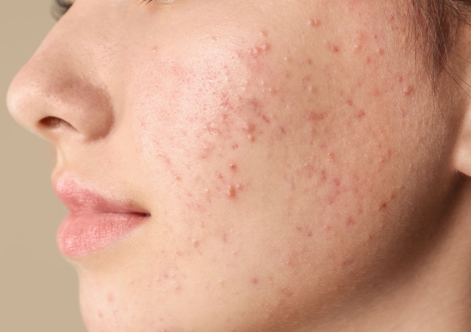 ACNE_shutterstock_1593164065