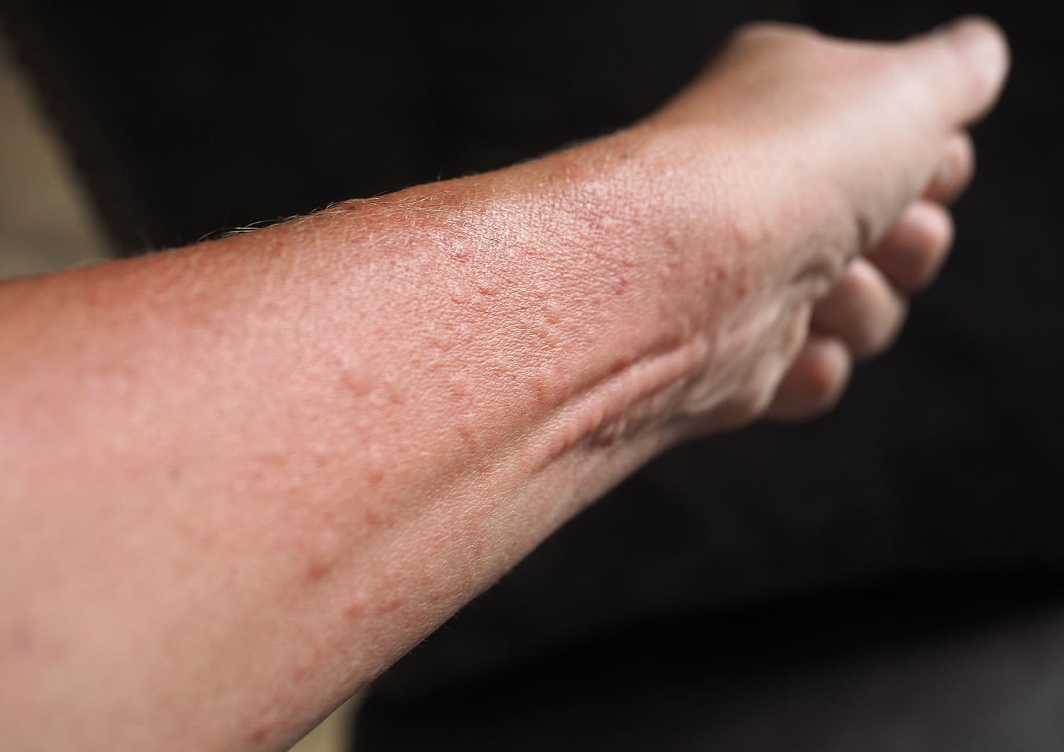 CONTACT DERMATITIS_shutterstock_696679450