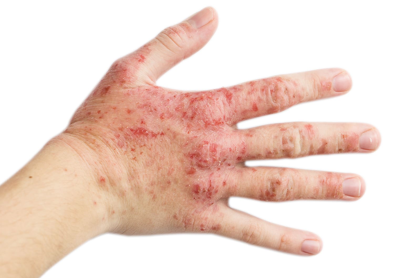 ECZEMA_shutterstock_242818321