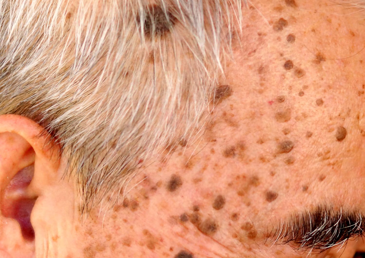 SEBORRHEIC KERATOSIS_shutterstock_451483849