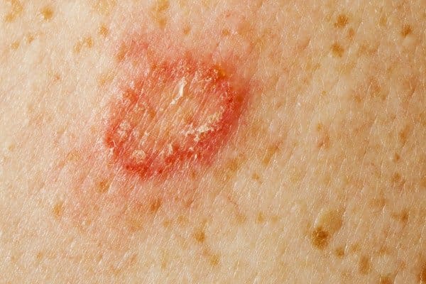Infectious Skin Disease - Mona Dermatology