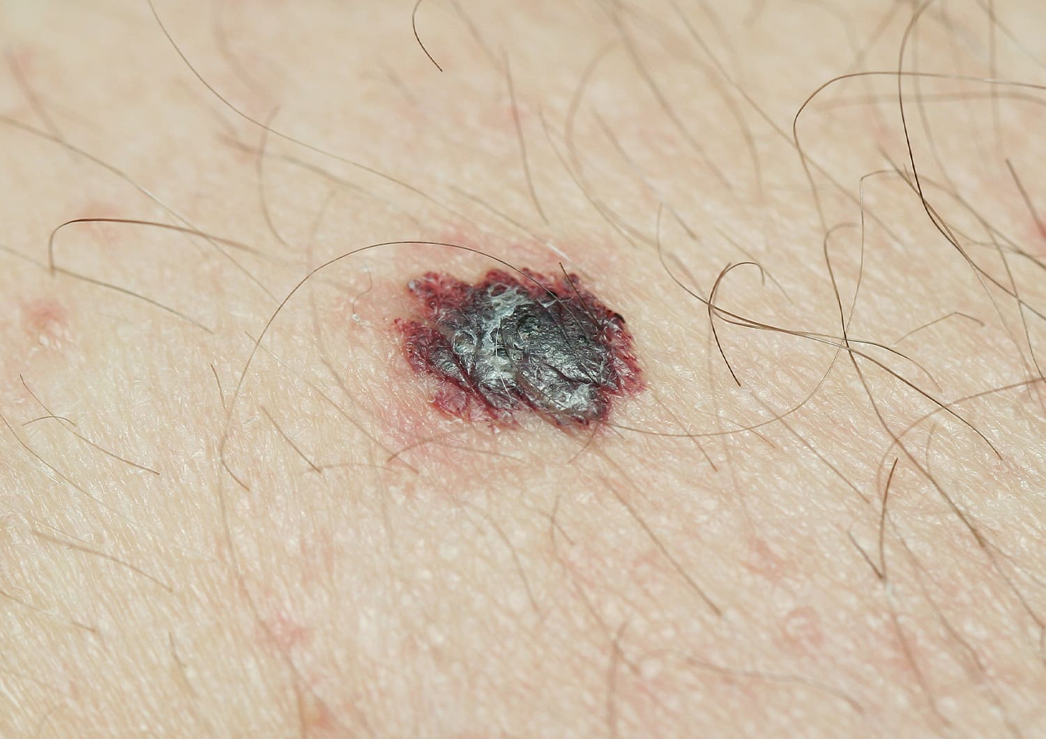 MELANOMA_shutterstock_603032861