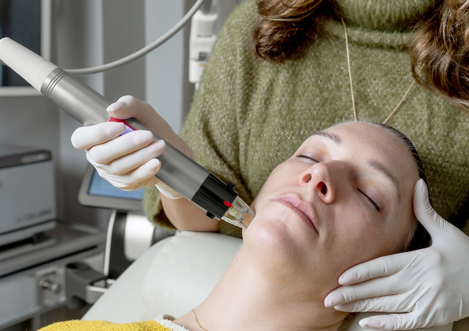 RadioFrequency Microneedling