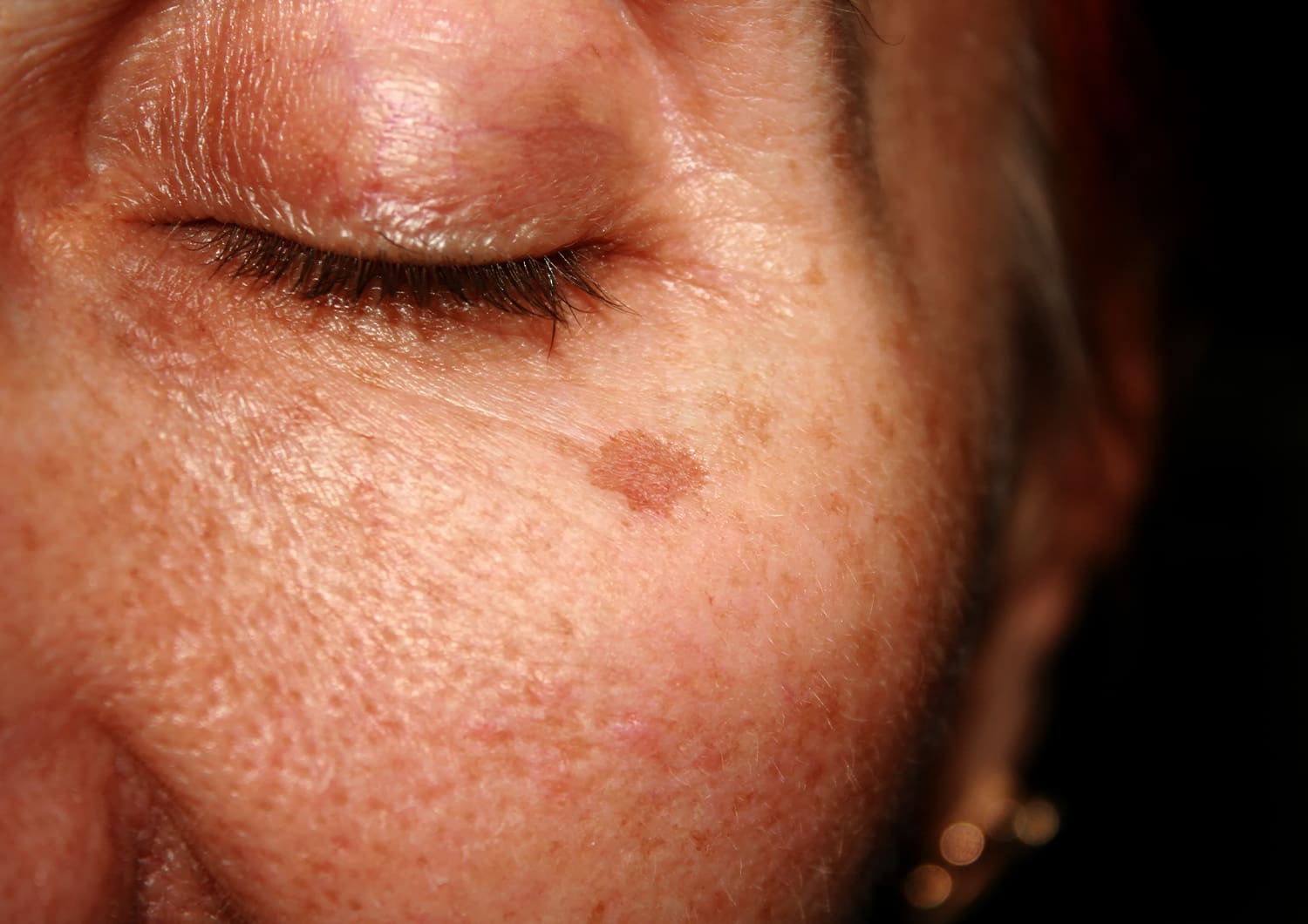 BROWN SPOTS, AGE SPOTS, & SUN DAMAGE_shutterstock_546160579