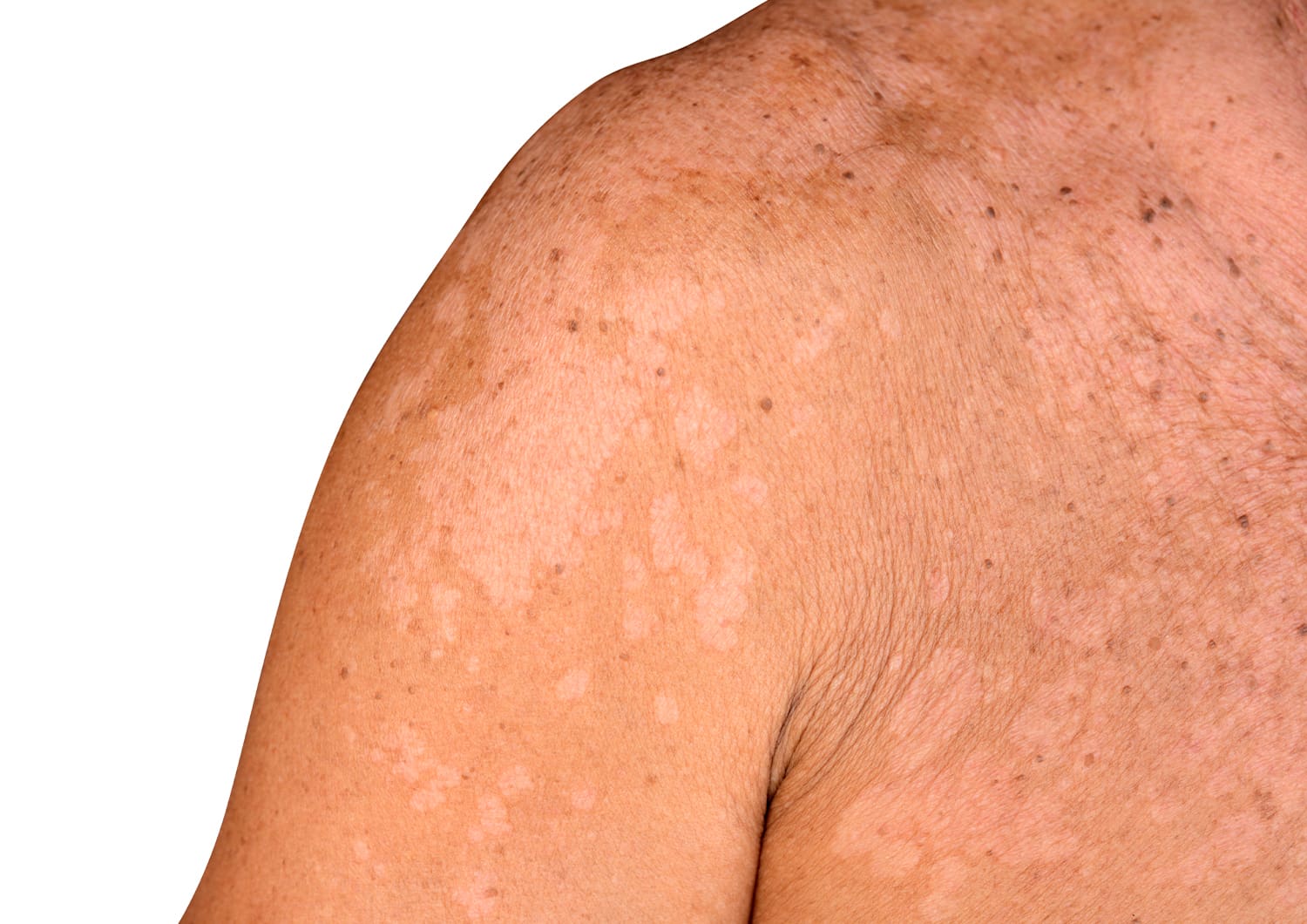 TINEA VERSICOLOR_shutterstock_460987033