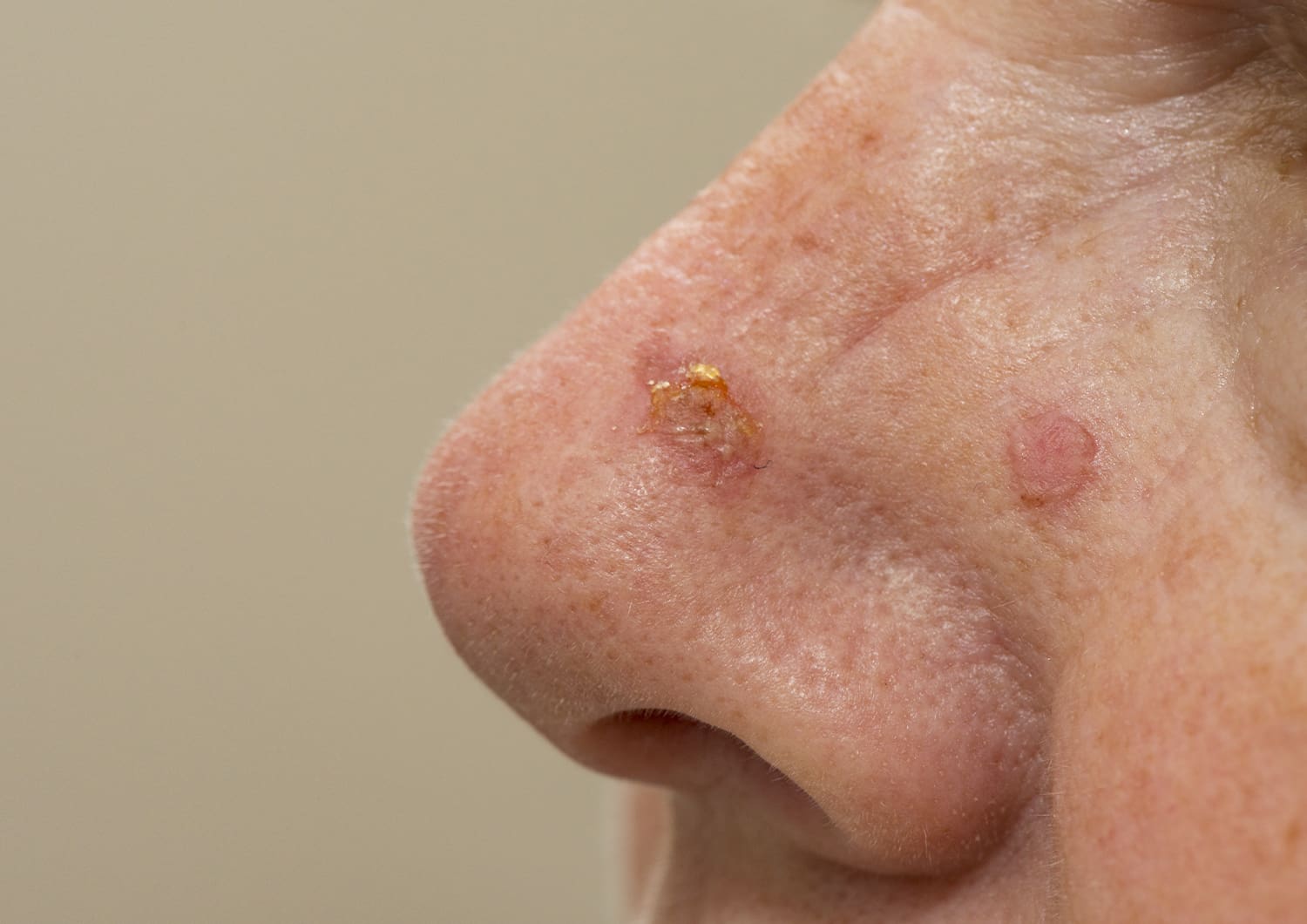 Actinic Keratosis