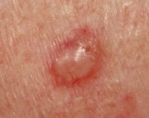 Photo of a basal cell carcinoma.