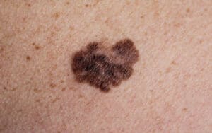 Photo of a melanoma.