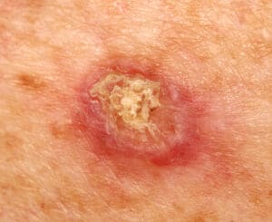 Photo of a squamous cell carcinoma.