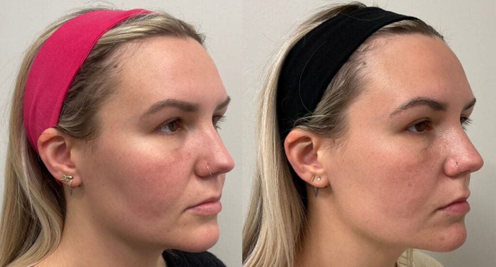 Volux Jawline Filler MONA Dermatology Cincinnati