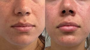 Lip filler results, Juvederm