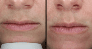 Lip flip results, Botox