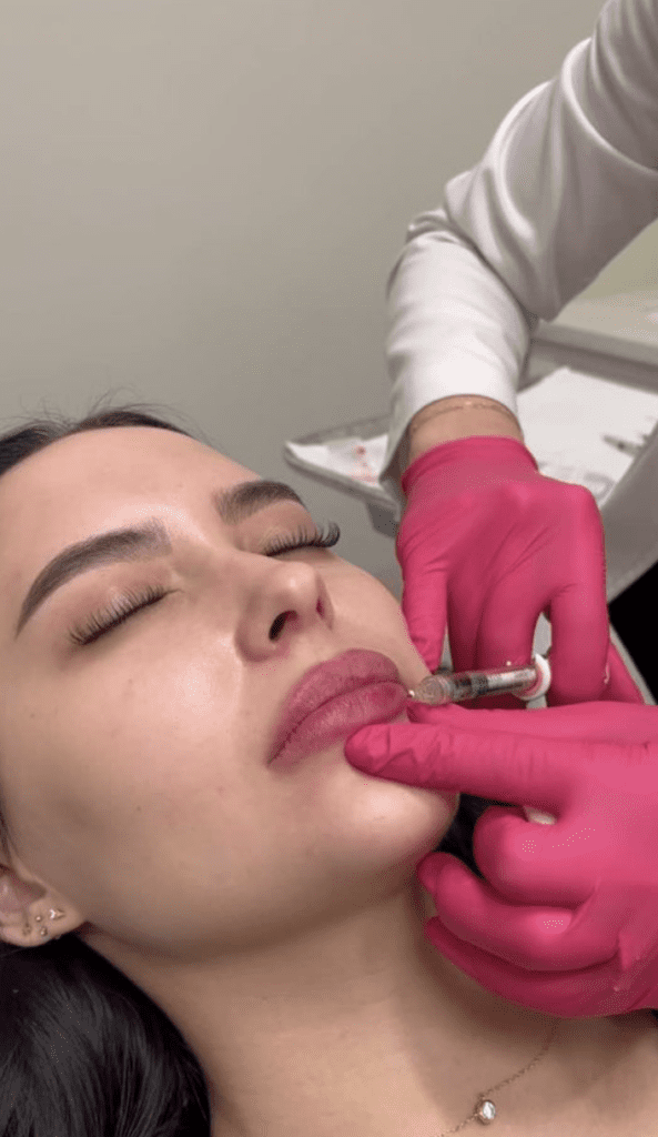 Lip filler vs lip flip, Juvederm, botox, filler