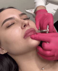 Lip filler vs lip flip, Juvederm, botox, filler