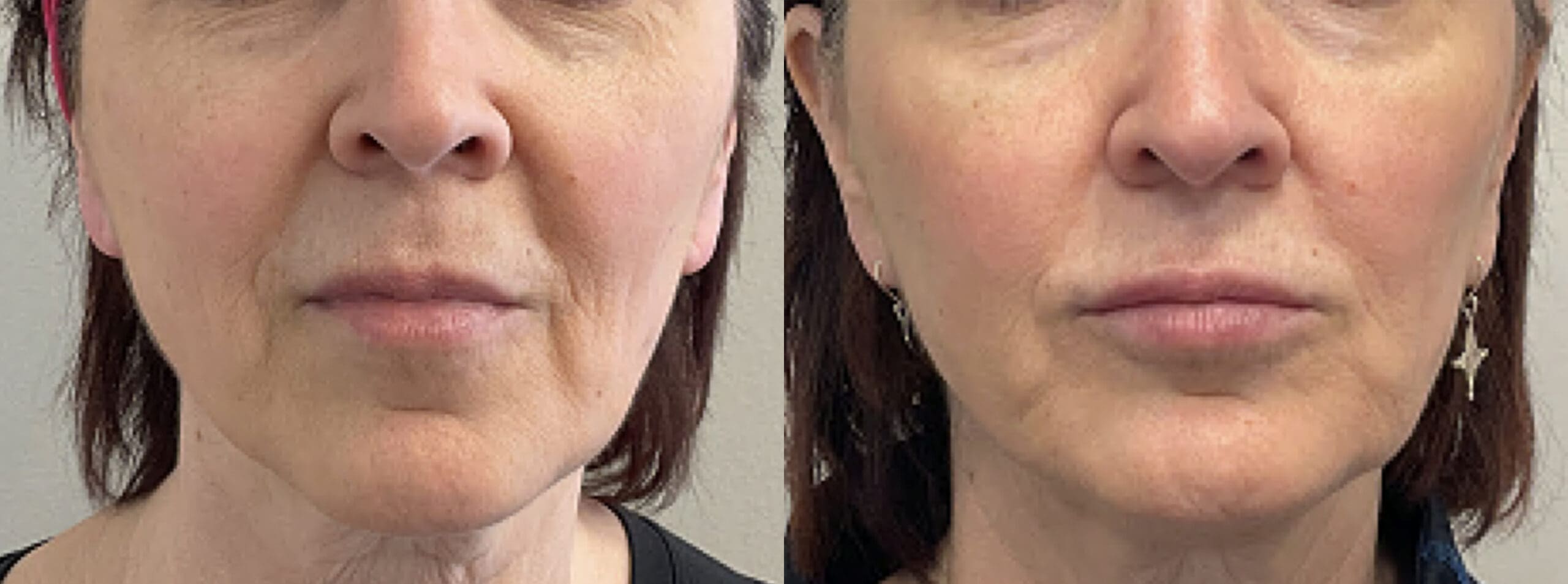 cheek filler placement before and after