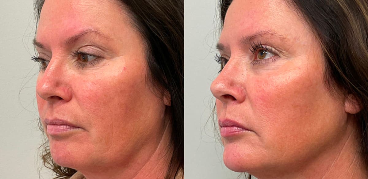 cheek filler placement before and after