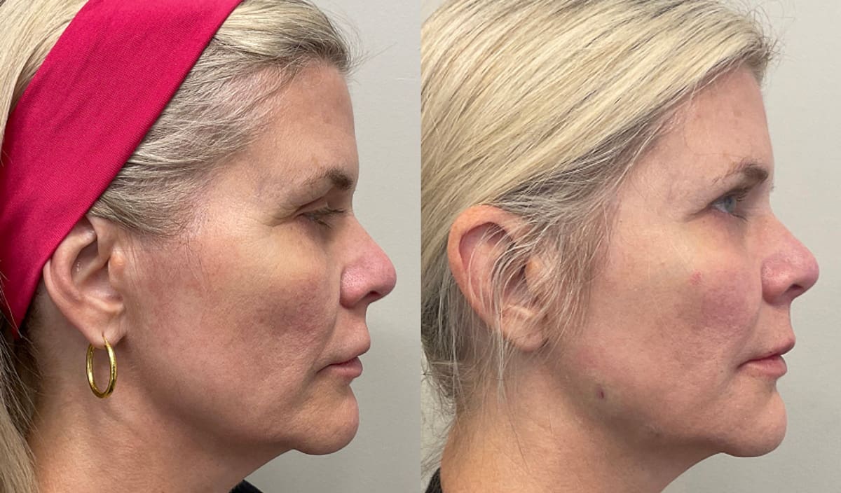 cheek filler placement before and after