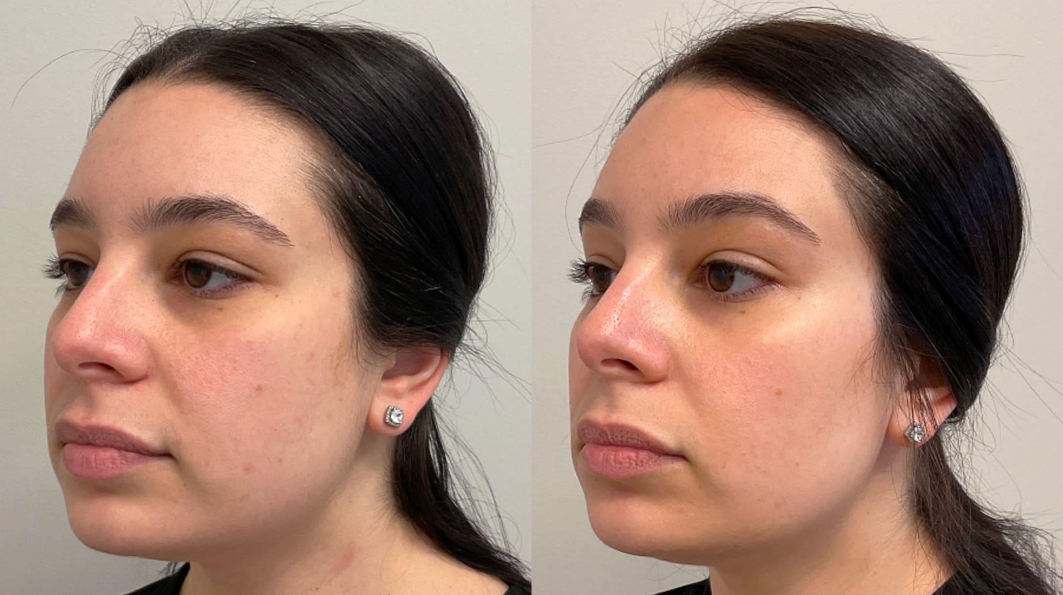 cheek filler placement volux jawline filler before and after